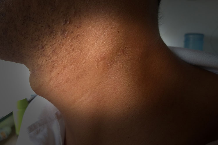 Brumado: Um ano após acidente, vítima faz campanha contra uso de linha de pipa com cerol