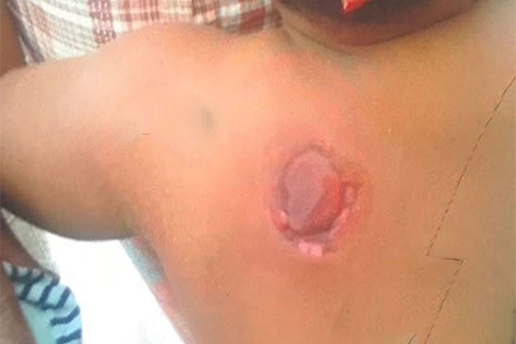 Guanambi: Criança é atacada e mordida por jumento que sofria maus tratos