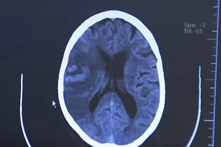AVC mata 1 brasileiro a cada 6 minutos, e 80% dos casos poderiam ser evitados