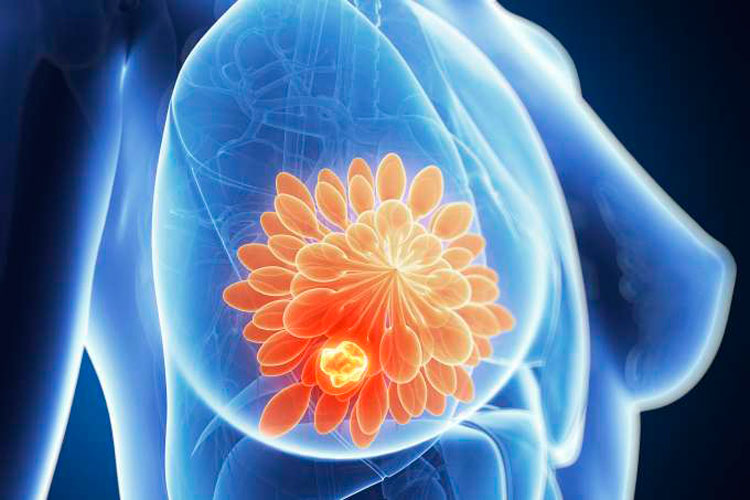 Seis novas mutações para câncer de mama e ovário são descobertas
