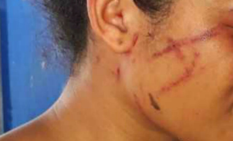 Jovem de 13 anos é agredida por ex-namorado e tem ferimentos no rosto em Teixeira de Freitas