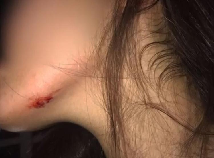 Iaçu: Adolescente atingida por pedra jogada por ex tem medida protetiva concedida
