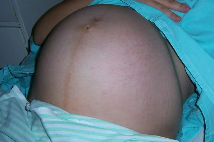 Anvisa autoriza vacina em grávidas para prevenir bronquiolite em bebês