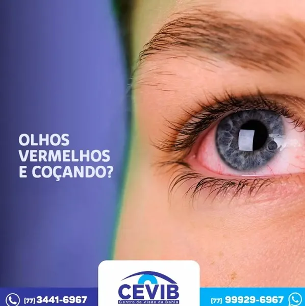 Cevib descreve possíveis causas dos olhos vermelhos e irritados