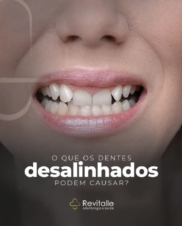 Revitalle Odontologia detalha inúmeros problemas decorrentes da falta de alinhamento dos dentes