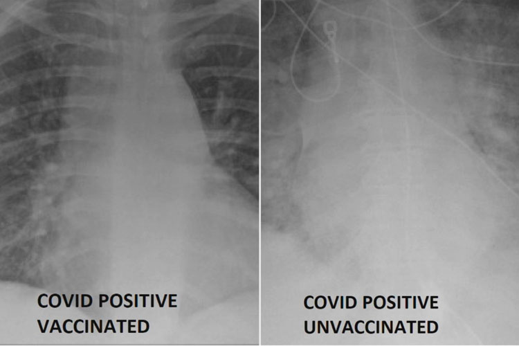 Raio X mostra diferenças da Covid em vacinados e não vacinados