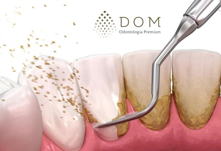 Saúde Bucal: Tratamento de tártaro na Dom Odontologia Premium em Brumado