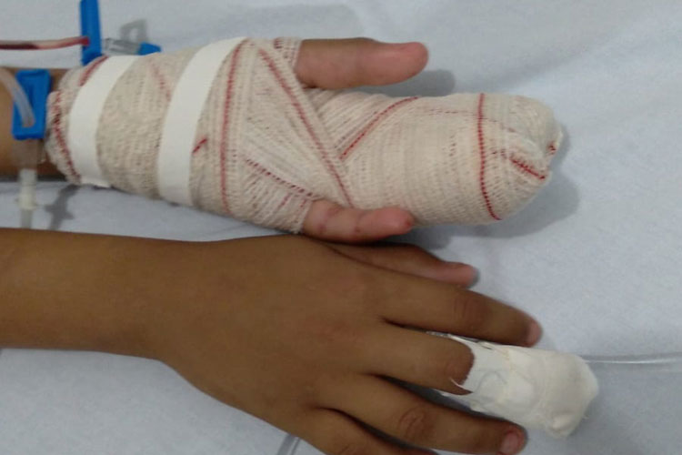 Brumado: Criança aguarda assistência após perder cabeça dos dedos em acidente em escola