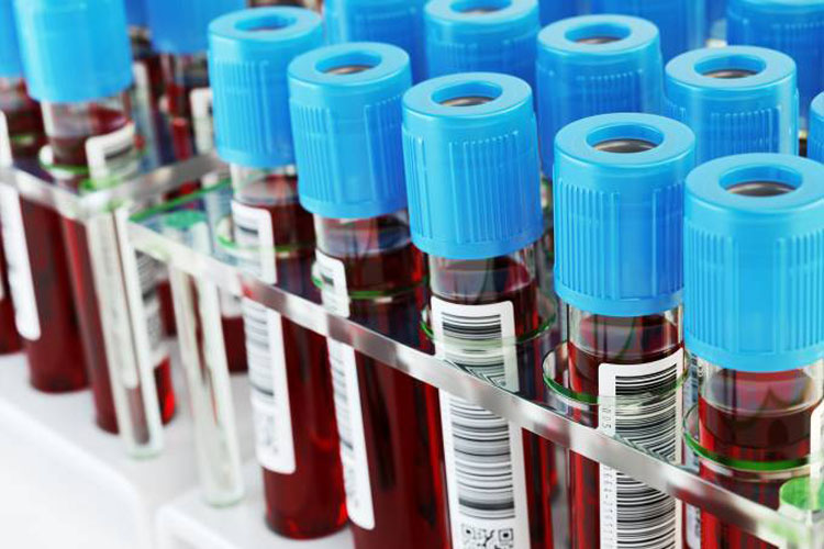 Saúde: Exame de sangue mostra melhor tratamento para câncer de próstata