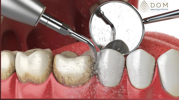 Faça a sua limpeza dental na Dom Odontologia Premium em Brumado