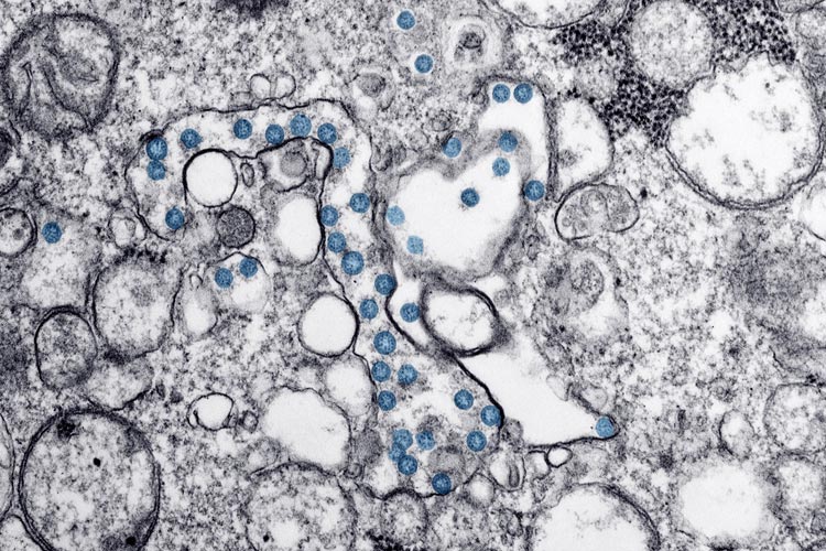 Covid-19 se espalhou pelo mundo mais devagar que H1N1, aponta estudo