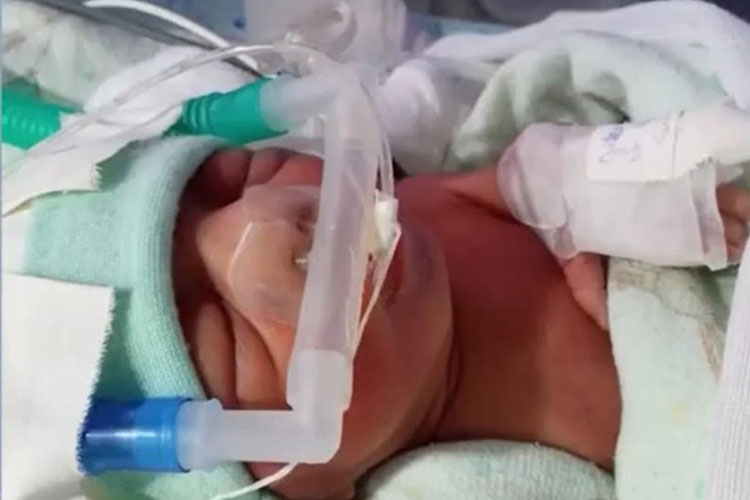 Conquista: Bebê nasce com cardiopatia congênita grave e precisa de cirurgia com urgência para sobreviver