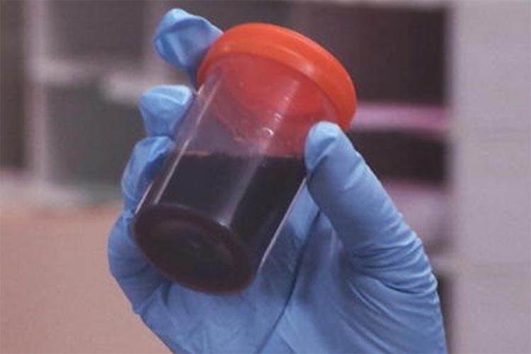 Oito casos de doença que deixa 'urina preta' são registrados este ano na Bahia