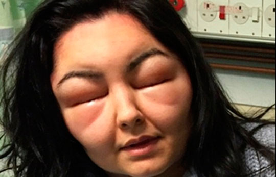 Jovem de 18 anos tem reação alérgica à tintura de cabelo e fica cega