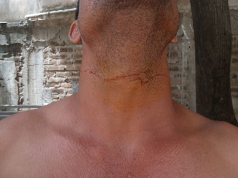 Brumado: Homem quase morre após ser atingido por cerol