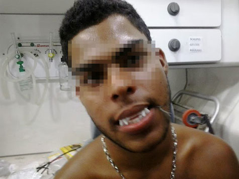 Ipiaú: Jovem faz cirurgia caseira e costura dentes de vampiro na própria boca