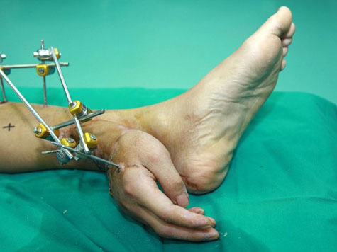 Mão de homem é reimplantada após ficar ligada ao tornozelo