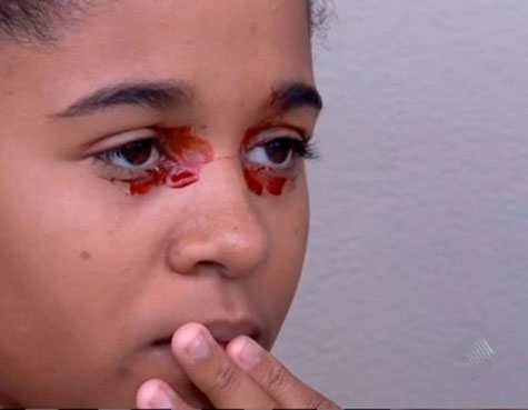 Aurelino Leal: Adolescente de 14 anos sofre com saída de sangue pelos olhos