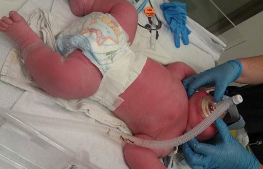 Bebê surpreende até os médicos e nasce com 7,4kg e 57cm