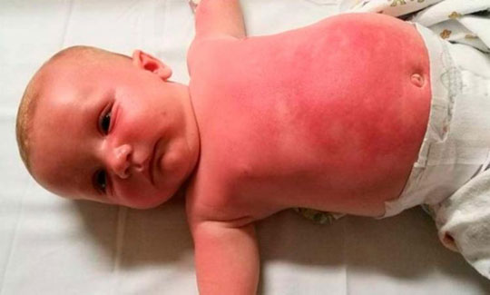 Bebê é internado na Austrália após uso de protetor solar