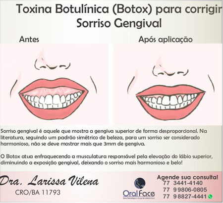Botox também é indicado para correção de sorriso gengival