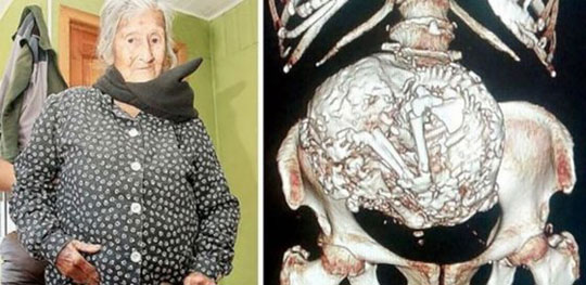 Idosa de 110 anos descobre que carrega feto calcificado há mais de 60 anos
