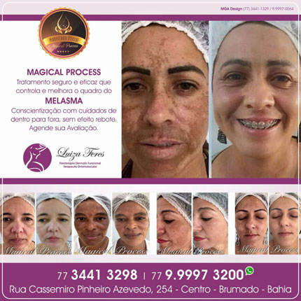 Clínica Luiza Feres dispõe do melhor tratamento para melasma