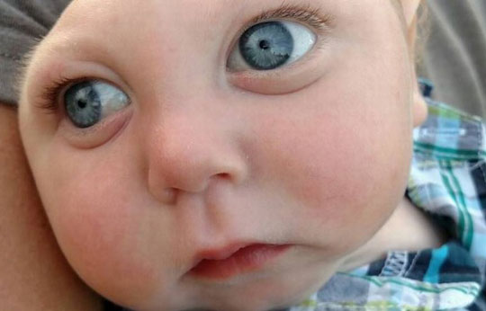 Bebê que nasceu sem parte do cérebro desafia ciência e comemora 1 ano de vida