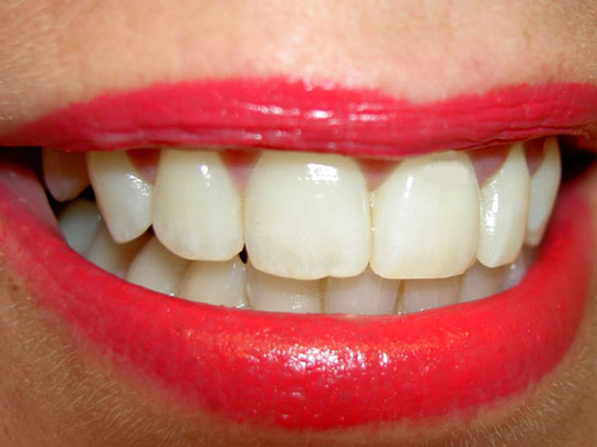Substância pode regenerar dentes e aposentar obturação