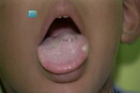 Criança tem língua cortada com faca por professora em creche de Salvador