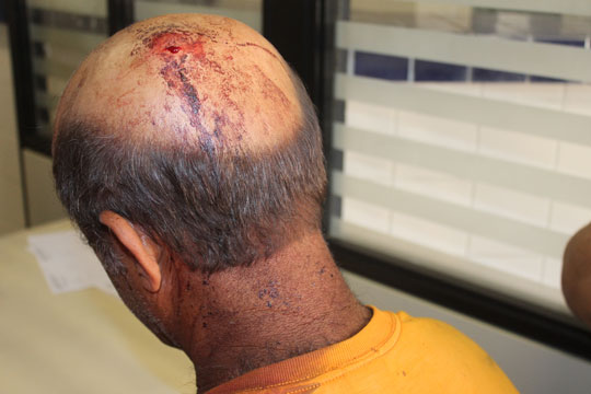Brumado: Cunhados brigam e idoso é golpeado com enxada