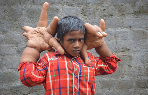 Índia: Menino de 8 anos tem mãos gigantes que pesam 13 quilos e medem 33 centímetros