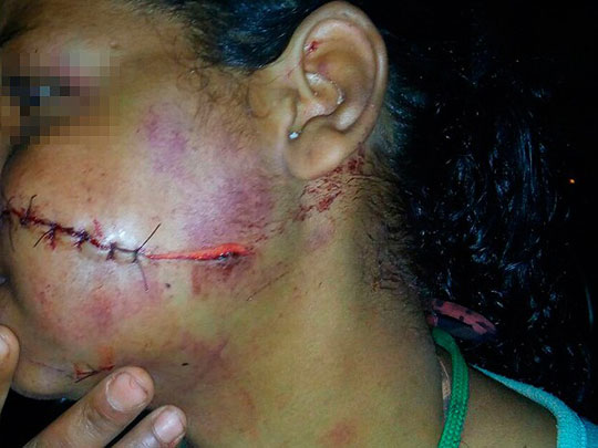 Luís Eduardo Magalhães: Mulher tem rosto 'rasgado' com faca em briga com companheiro