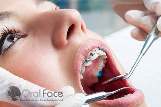 Oral Face: Aparelhos Ortodônticos Autoligados