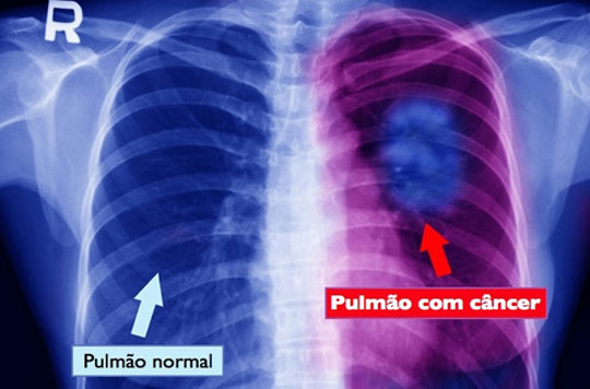 Casos de câncer no pulmão estão aumentando em Caetité devido a extração de urânio