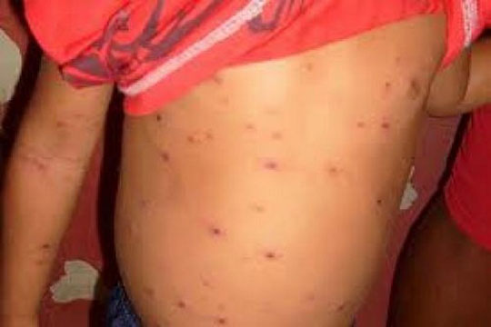 Surtos de sarampo no Brasil mostram problemas na imunização