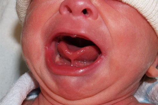 Norma obriga hospitais e maternidades a realizarem o teste da linguinha em recém-nascidos
