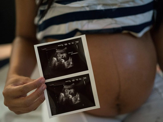 Segundo estudo, microcefalia ocorre em 1% dos casos de grávidas com zika